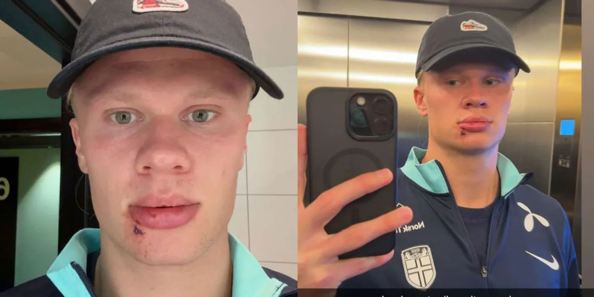 Erling Haaland Dijahit 3 Tusukan Usai Terbentur dengan Pintu Bus!